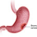 Stomach Cancer Causes, Prevention, Risks & Complications and Treatment.