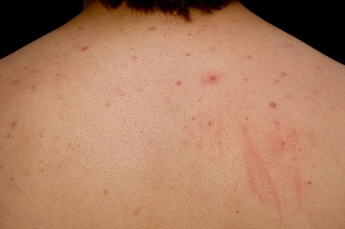http://www.goohealty.tk/2015/02/how-to-get-rid-of-acne-on-your-back.html