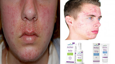 http://about-skinacne.blogspot.co.id/