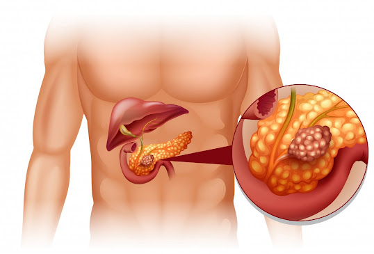 Exocrine Pancreatic Insufficiency (EPI) Therapeutics