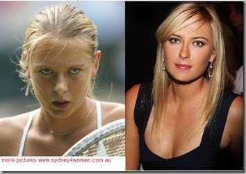 maria-sharapova-before-after-rhinoplasty-cosmetic-surgery1