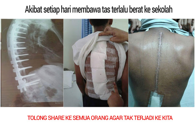 HATI-HATI!! Jangan Biarkan Anak Kita Membawa Tas Sekolah yang Terlalu Berat Setiap Hari! Ini Dampak Negatifnya..