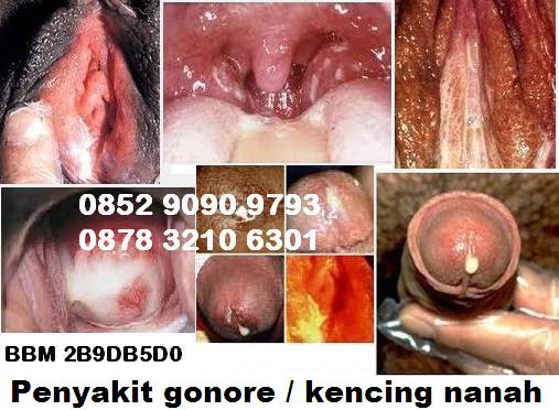 Ramuan Tradisional Obat Kencing Sakit Keluar Nanah