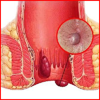 piles, hemorrhoids