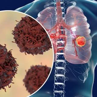 Oncologists Highlight 13 Lung Cancer Symptoms You Shouldn't Ignore