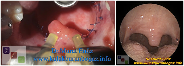 Tonsillectomy Operation in Istanbul