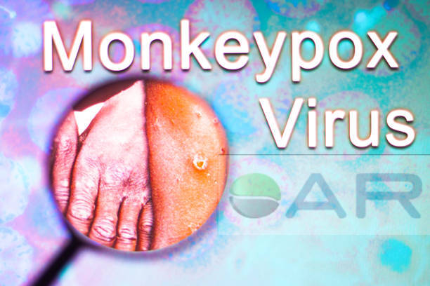 Monkeypox :  Anvisa recomenda distância mínima de 1 metro entre leitos - primeiro caso em SP