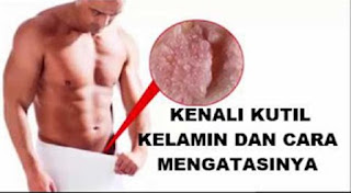 Cara herbal mengobati kutil kelamin atau kutil di kemaluan, obat nyeri pada kutil kelamin, obat kutil kelamin atau kutil di kemaluan yang aman buat ibu menyusui, kutil kemaluan pria, obat tradisional untuk kutil kelamin luar, obat kutil kelamin yg aman buat ibu hamil, ciri kutil kelamin atau kutil di kemaluan pada wanita, mengobati kutil kelamin dengan cuka apel, cara penyembuhan kutil di kemaluan, kutil kelamin pada ibu hamil, menghilangkan virus kutil kelamin