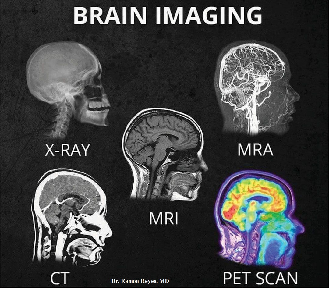 Imágenes del Cerebro: Rayos X, Resonancia Magnética, Tomografía, Pet-S ...