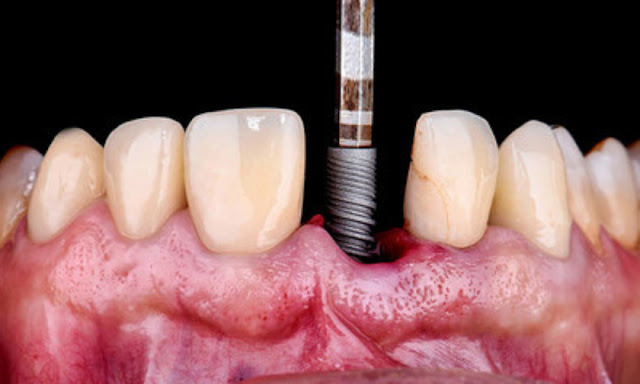 know about dental implants