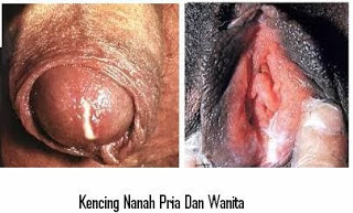 gejala kencing nanah pada pria dan wanita