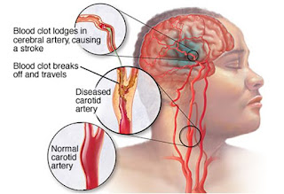 Obat Herbal Ampuh Untuk Stroke, Faktor Resiko Penyakit Stroke Pdf, Jual Obat Alami Stroke Obat Stroke Herbal, Pengobatan Stroke Pada Mata, Cara Mengobati Stroke Akibat Hipertensi, Obat Tradisional Sakit Stroke, Obat Alami Gejala Stroke, Penyakit Stroke Menurut Islam, Obat Herbal Untuk Stroke Hemoragik, Cara Mengobati Penyakit Stroke, Pengobatan Stroke Jogja, Pengobatan Stroke Pendarahan Otak, Obat Herbal Untuk Pasien Stroke, Cara Pengobatan Stroke Ringan, Jual Obat Herbal Stroke 