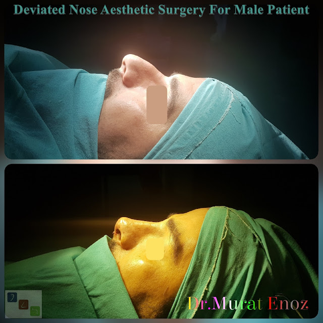 Deviated Nose Aesthetic Surgery, Asymmetric Nose Correction Operation,Rhinoplasty in Men Istanbul,