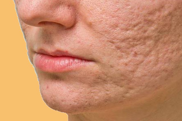 A Few Simple Home Acne Treatment Methods for Teens