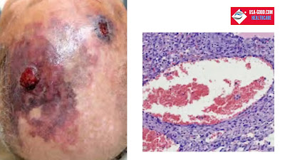 What is Angiosarcoma?