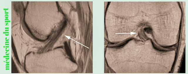 IMAGERIE DU GENOU APPLIQUÉE A LA PATHOLOGIE SPORTIVE