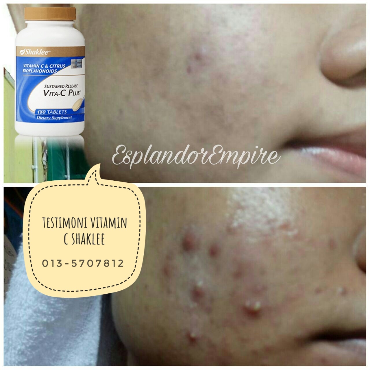 Testimoni Vitamin C Untuk Jerawat