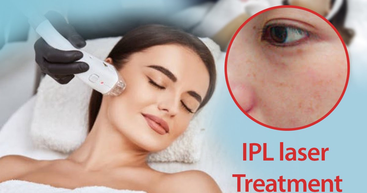 Quality Healthcare and Wellness Center | Skin Treatment New Jersey: What Makes the IPL Laser Treatment a One-Stop Aesthetical Solution?