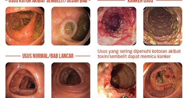 Ubat Yang Bagus Untuk Gastrik - Descar 4