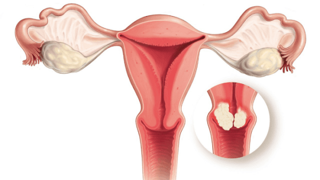 what-causes-cervical-cancer
