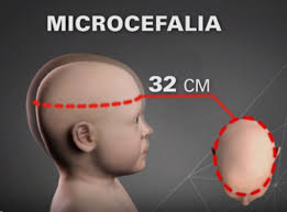 MICROCEFALIA