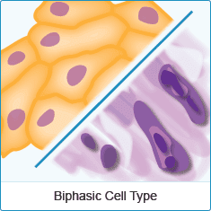 Mesothelioma And Epithelial Differentiation