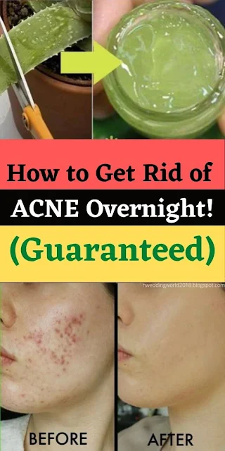 How to Get Rid of ACNE Overnight! (Guaranteed)
