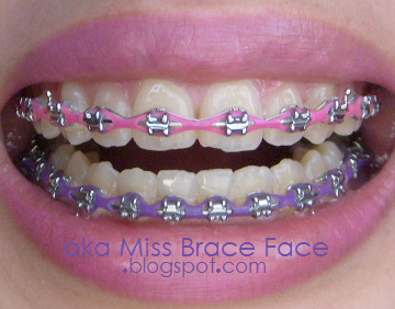 A.K.A. Miss Brace Face: Appointment: February 23, 2010