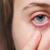 आंखों में सूखापन क्यों आता है? जानें ये 4 कारण | Dry eye syndrome cause