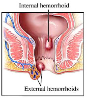 Obat Hemorroid Tanpa Operasi Yang Ampuh
