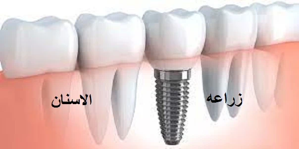 زراعة الأسنان الفورية..تقنية العلاج بالليزر البارد