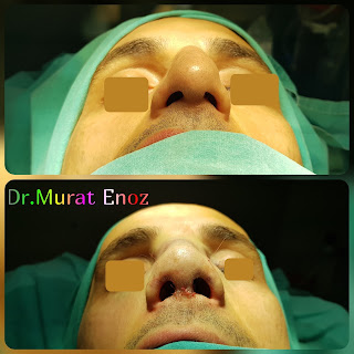 Nasal valve collapse,Alar collapse,Septorhinoplasty in istanbul,Rhinoplasty in men Turkey,