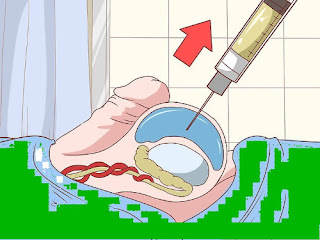 what is hydrocele?