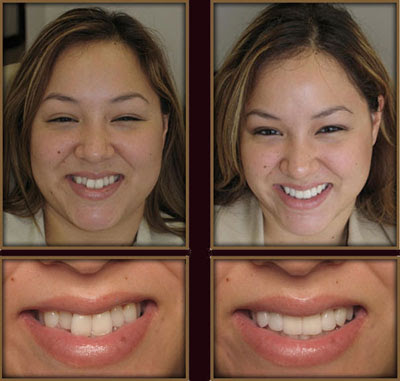 Veneers Before And After Smiles