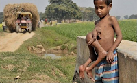 Baby with four legs in the abdomen