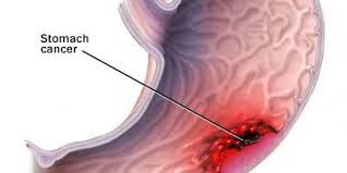 Câncer-de-estômago-sintomas-causas-diagnóstico-tratamento-prognóstico