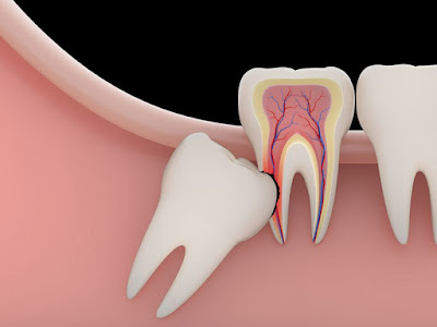 Răng khôn mọc ngược vào xương hàm có nguy hiểm? 