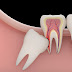 Răng khôn mọc ngược vào xương hàm có nguy hiểm? 