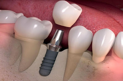 Thời điểm làm răng giả nguyên hàm thích hợp nhất 2