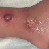 Nokardiosis