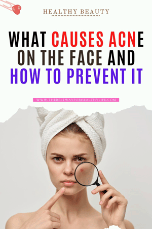picture what causes acne on the face and how to prevent it
