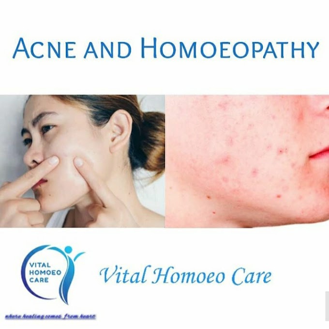 Homoeopathic Treatment of Acne