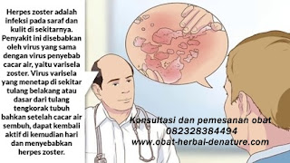 obat herpes kelamin,obat herpes zoster,obat cacar dompo,obat cacar air,obat herpes kemaluan,obat herpes tangan,obat herpes bibir,obat herpes badan