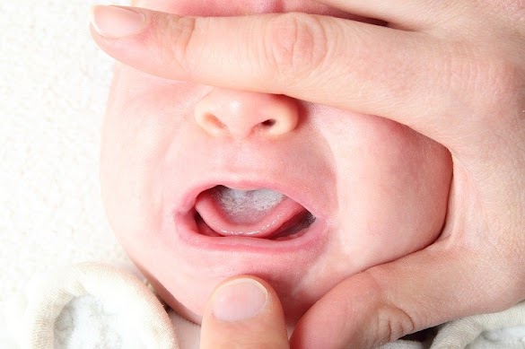 Mouth Problems in Baby that You Should Know