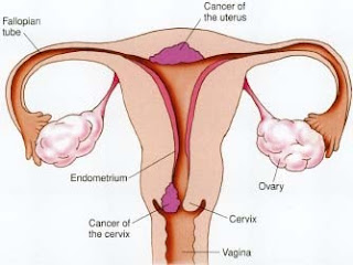 Risk factors for the occurrence of CA cervix, endometrium and ovaries