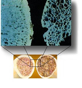 osteoporosis