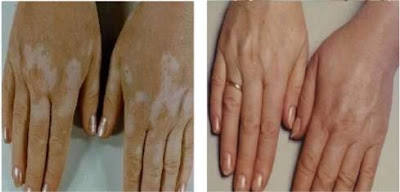 http://www.vitiligo-surgery.com