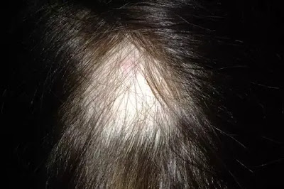 Dandruff and Heavy hair loss