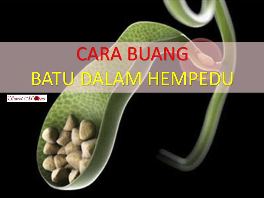 Buang Batu Dalam Hempedu Tanpa Ubat Dan Pembedahan 