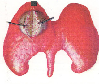 Malignant thyroid tumors